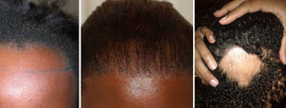 Black women with  thinning or receding hairlines-CURLSQUEEN blog